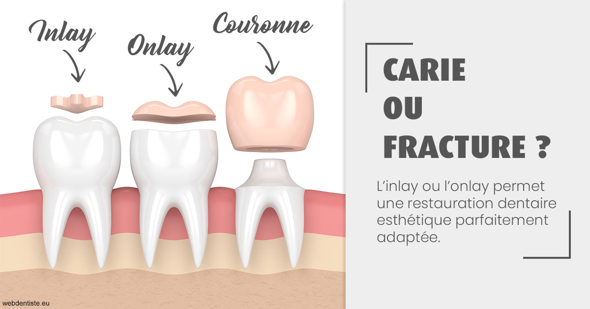 https://dr-infante-christian.chirurgiens-dentistes.fr/T2 2023 - Carie ou fracture 1
