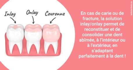 https://dr-infante-christian.chirurgiens-dentistes.fr/L'INLAY ou l'ONLAY 2