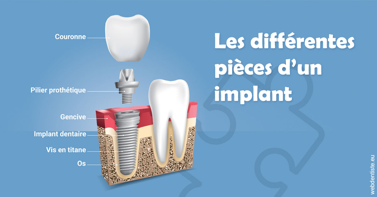https://dr-infante-christian.chirurgiens-dentistes.fr/Les différentes pièces d’un implant 1